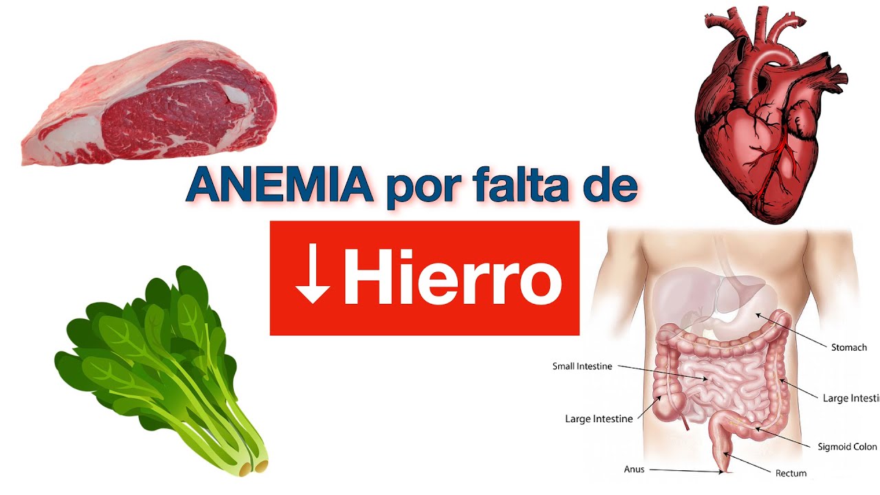 Anemia Por Deficiencia De Hierro