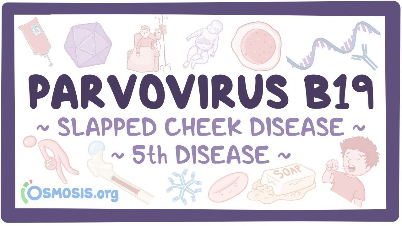 Parvovirus B19