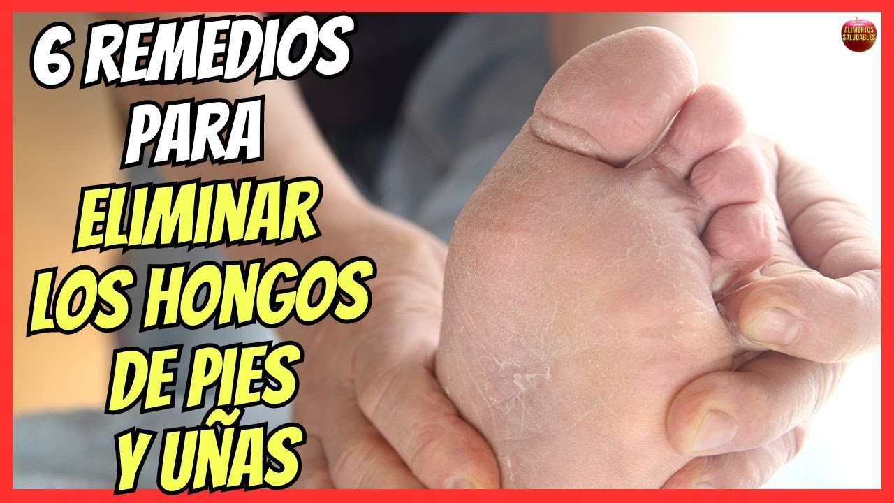 Remedios Caseros Para Hongos En Las Uñas De Los Pies