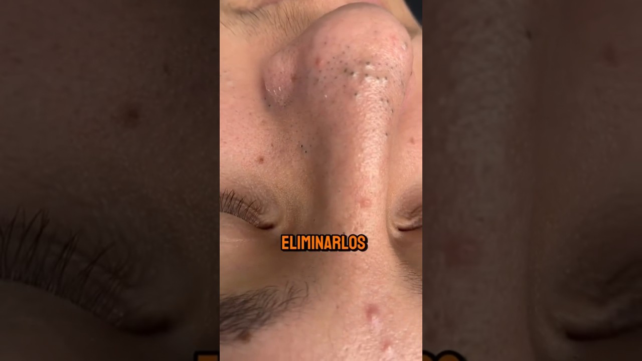 Sacar Espinillas De La Cara