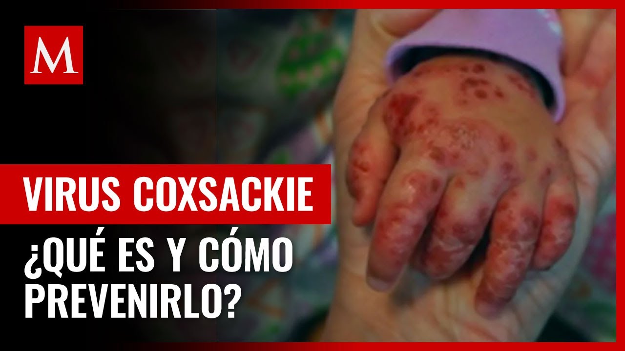 Virus Coxsackie