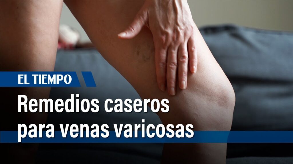 Remedios caseros para varices en las piernas: ¡Adiós arañitas, hola ...