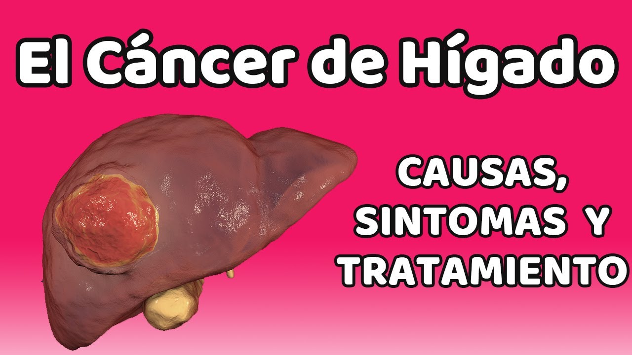 Cancer de higado tiene cura
