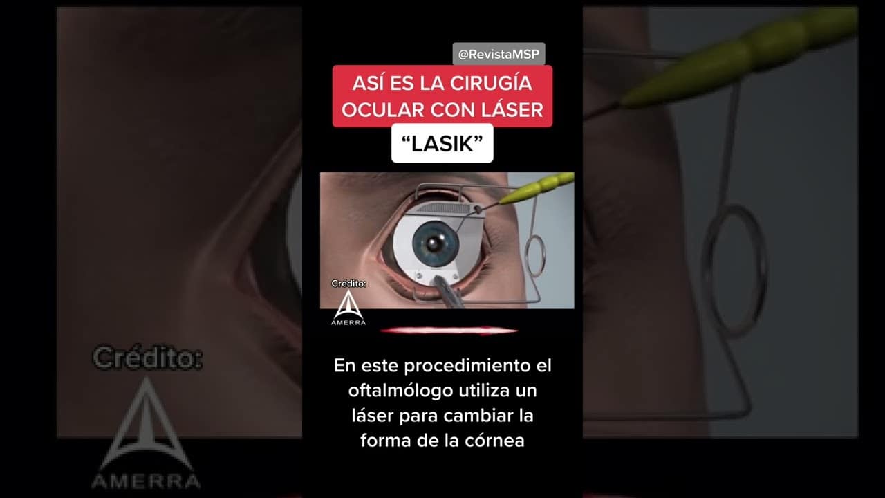 Cirugía ocular