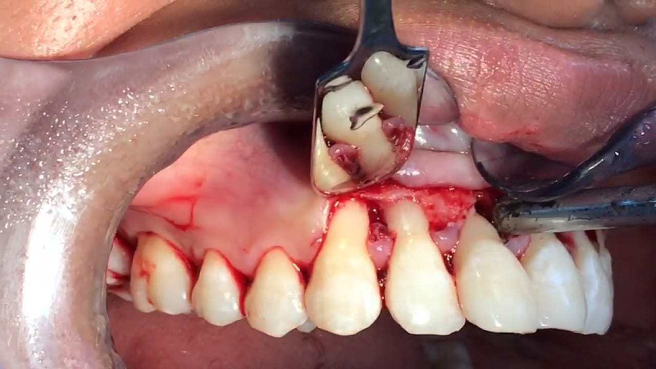 Cirugía periodontal