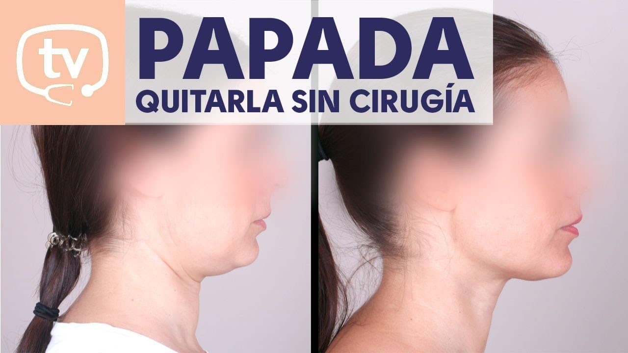 Eliminar papada sin cirugía