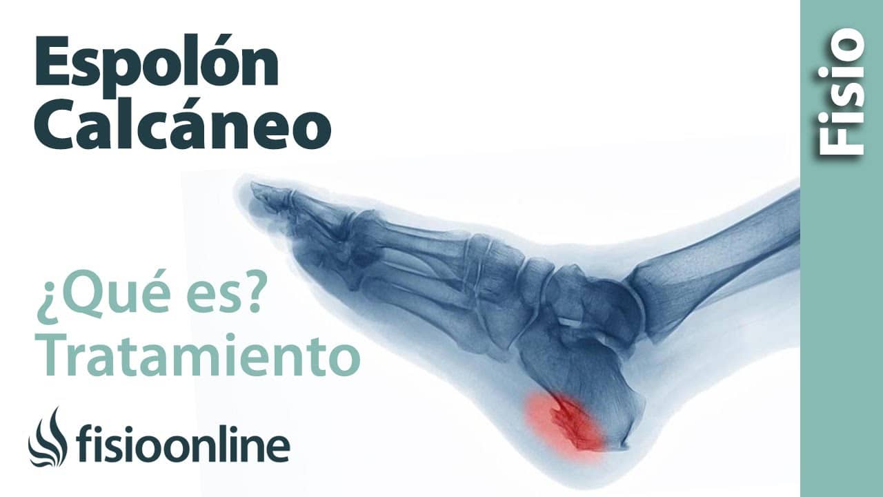 Qué es un espolón en el talón y cómo se puede curar